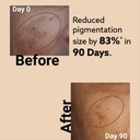 melora-skin-fade-melasma-hyperpigmentati-61736rPoPyL.jpg