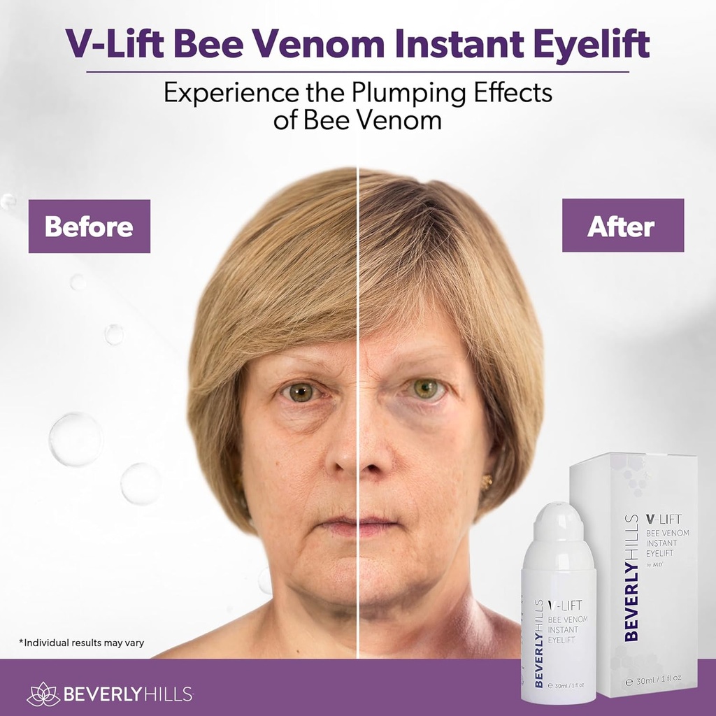 beverly-hills-v-lift-instant-eye-lift-an-3.jpg