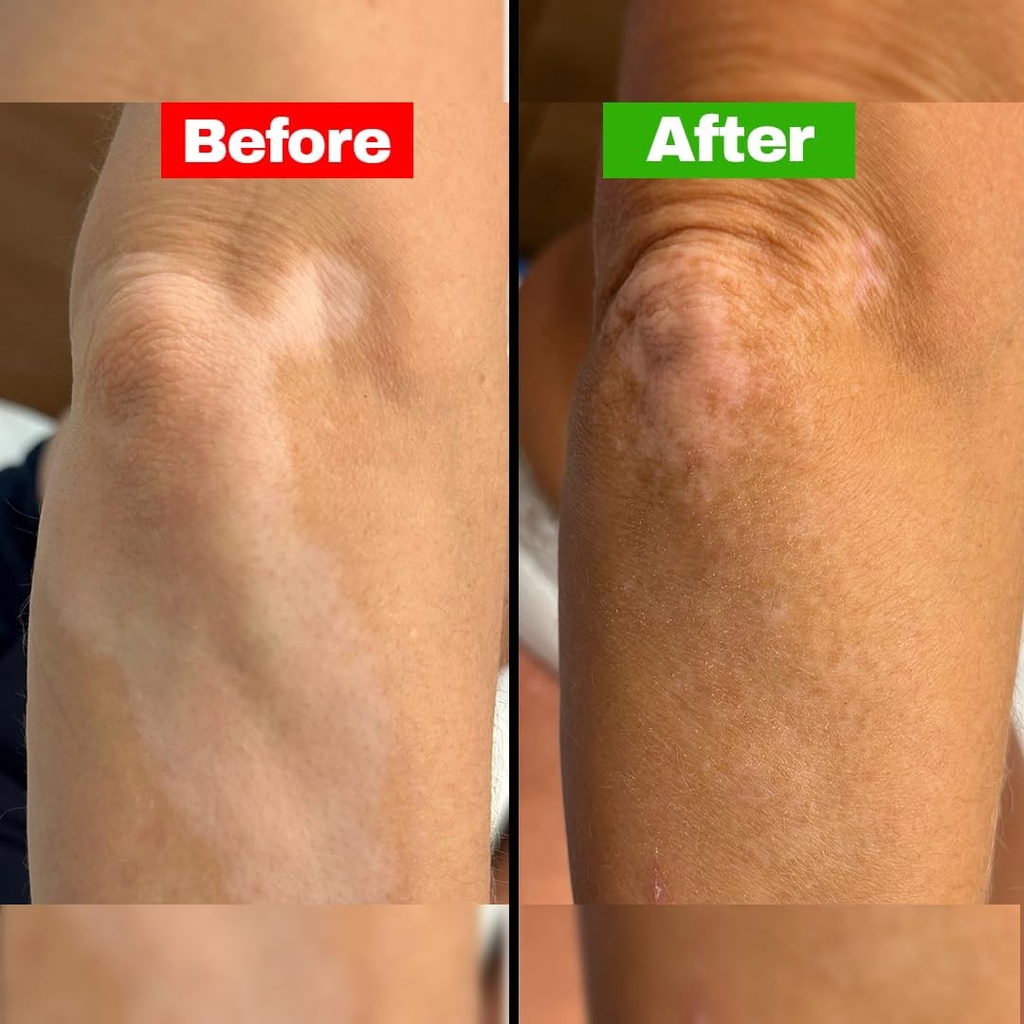 siya-ayurveda-psoriasis-treatment-oil-fo-6.jpg