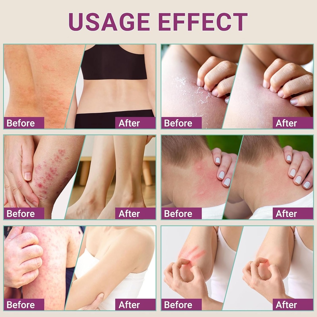 anti-itch-cream-extra-strength-anti-itch-6.jpg