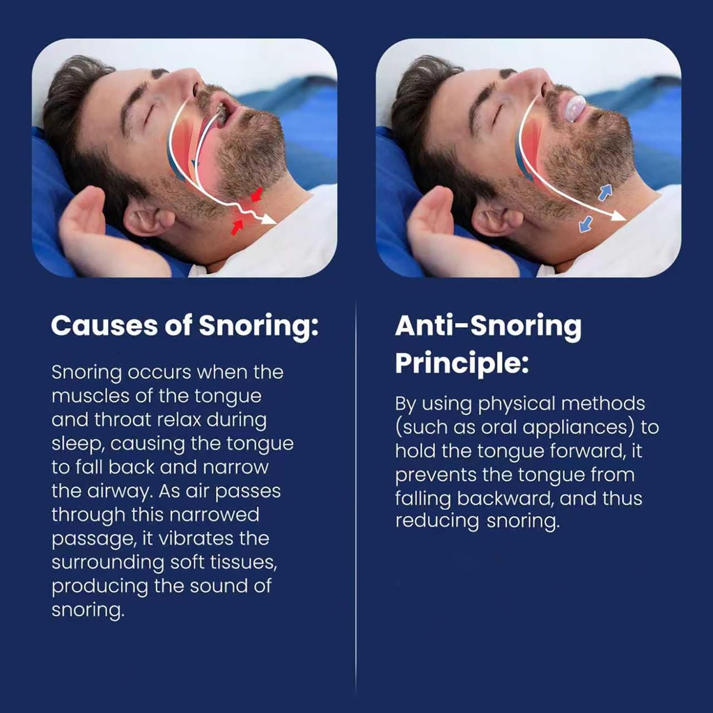 tongue-stabilizing-device-mouthpiece-fda-4.jpg